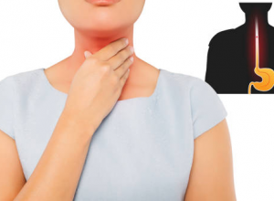  Có thể bạn chưa biết: Trào ngược dạ dày thực quản là nguyên nhân gây viêm họng nặng